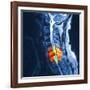 Slipped Disc, MRI Scan-PASIEKA-Framed Photographic Print