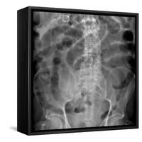 Small Bowel Obstruction, X-ray-Du Cane Medical-Framed Stretched Canvas