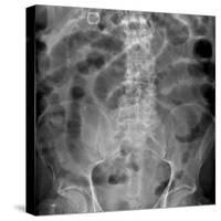 Small Bowel Obstruction, X-ray-Du Cane Medical-Stretched Canvas