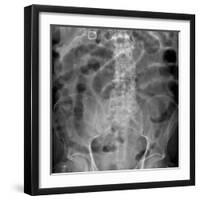 Small Bowel Obstruction, X-ray-Du Cane Medical-Framed Photographic Print