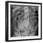 Small Bowel Obstruction, X-ray-Du Cane Medical-Framed Photographic Print
