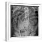 Small Bowel Obstruction, X-ray-Du Cane Medical-Framed Photographic Print