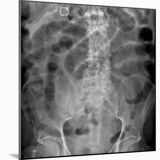 Small Bowel Obstruction, X-ray-Du Cane Medical-Mounted Photographic Print