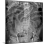 Small Bowel Obstruction, X-ray-Du Cane Medical-Mounted Photographic Print