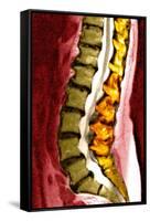 Spine Degeneration, MRI Scan-Du Cane Medical-Framed Stretched Canvas