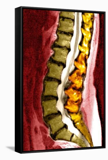 Spine Degeneration, MRI Scan-Du Cane Medical-Framed Stretched Canvas