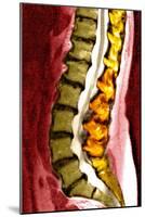 Spine Degeneration, MRI Scan-Du Cane Medical-Mounted Photographic Print