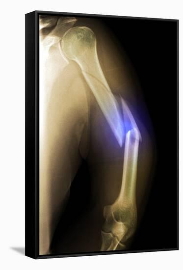 Splintered Arm Fracture, X-ray'-Du Cane Medical-Framed Stretched Canvas