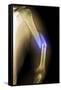 Splintered Arm Fracture, X-ray'-Du Cane Medical-Framed Stretched Canvas