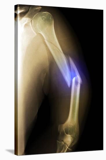 Splintered Arm Fracture, X-ray'-Du Cane Medical-Stretched Canvas