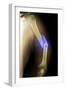 Splintered Arm Fracture, X-ray'-Du Cane Medical-Framed Photographic Print