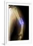 Splintered Arm Fracture, X-ray'-Du Cane Medical-Framed Photographic Print