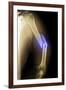 Splintered Arm Fracture, X-ray'-Du Cane Medical-Framed Photographic Print