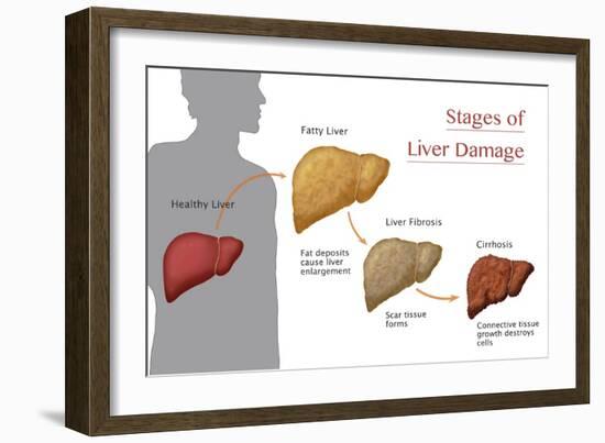 Stages of Liver Damage-Monica Schroeder-Framed Giclee Print