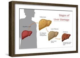 Stages of Liver Damage-Monica Schroeder-Framed Giclee Print
