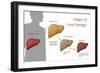 Stages of Liver Damage-Monica Schroeder-Framed Giclee Print