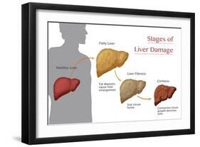 Stages of Liver Damage-Monica Schroeder-Framed Giclee Print