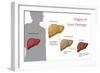 Stages of Liver Damage-Monica Schroeder-Framed Giclee Print