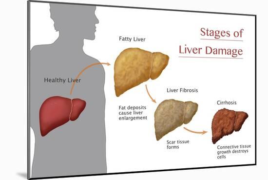 Stages of Liver Damage-Monica Schroeder-Mounted Giclee Print