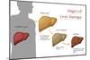 Stages of Liver Damage-Monica Schroeder-Mounted Giclee Print
