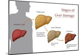 Stages of Liver Damage-Monica Schroeder-Mounted Giclee Print