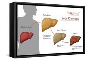 Stages of Liver Damage-Monica Schroeder-Framed Stretched Canvas