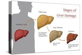 Stages of Liver Damage-Monica Schroeder-Stretched Canvas