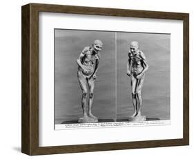 Statuette of an Old Woman with Parkinson's Disease, After 1895-Paul Marie Louis Pierre Richer-Framed Giclee Print