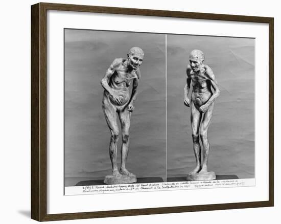 Statuette of an Old Woman with Parkinson's Disease, After 1895-Paul Marie Louis Pierre Richer-Framed Giclee Print