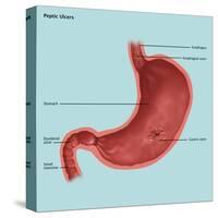 Stomach Ulcers, Illustration-Gwen Shockey-Stretched Canvas