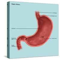 Stomach Ulcers, Illustration-Gwen Shockey-Stretched Canvas