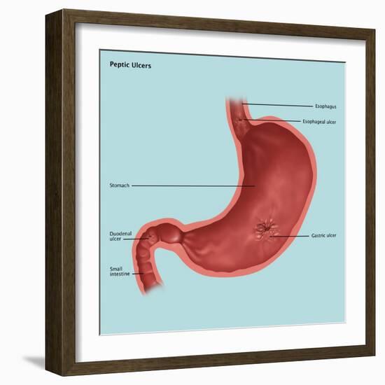 Stomach Ulcers, Illustration-Gwen Shockey-Framed Giclee Print