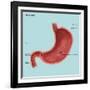 Stomach Ulcers, Illustration-Gwen Shockey-Framed Premium Giclee Print