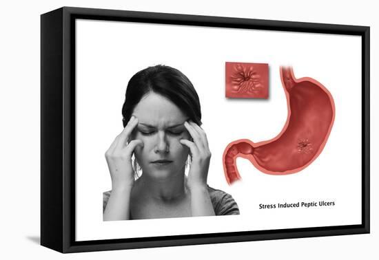 Stress Ulcer, Conceptual Illustration-Gwen Shockey-Framed Stretched Canvas