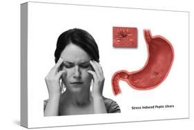 Stress Ulcer, Conceptual Illustration-Gwen Shockey-Stretched Canvas