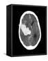 Subarachnoid Haemorrhage, MRI Scan-Du Cane Medical-Framed Stretched Canvas