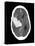 Subarachnoid Haemorrhage, MRI Scan-Du Cane Medical-Stretched Canvas