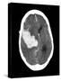 Subarachnoid Haemorrhage, MRI Scan-Du Cane Medical-Stretched Canvas