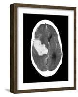 Subarachnoid Haemorrhage, MRI Scan-Du Cane Medical-Framed Photographic Print