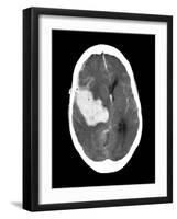 Subarachnoid Haemorrhage, MRI Scan-Du Cane Medical-Framed Photographic Print