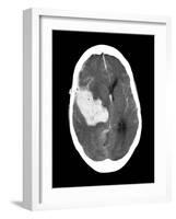 Subarachnoid Haemorrhage, MRI Scan-Du Cane Medical-Framed Photographic Print