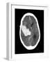 Subarachnoid Haemorrhage, MRI Scan-Du Cane Medical-Framed Photographic Print