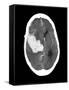 Subarachnoid Haemorrhage, MRI Scan-Du Cane Medical-Framed Stretched Canvas
