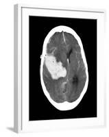 Subarachnoid Haemorrhage, MRI Scan-Du Cane Medical-Framed Photographic Print