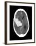 Subarachnoid Haemorrhage, MRI Scan-Du Cane Medical-Framed Photographic Print