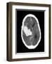 Subarachnoid Haemorrhage, MRI Scan-Du Cane Medical-Framed Photographic Print
