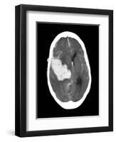 Subarachnoid Haemorrhage, MRI Scan-Du Cane Medical-Framed Photographic Print