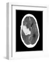 Subarachnoid Haemorrhage, MRI Scan-Du Cane Medical-Framed Photographic Print