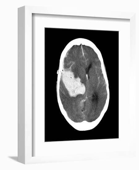 Subarachnoid Haemorrhage, MRI Scan-Du Cane Medical-Framed Photographic Print