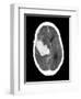 Subarachnoid Haemorrhage, MRI Scan-Du Cane Medical-Framed Photographic Print